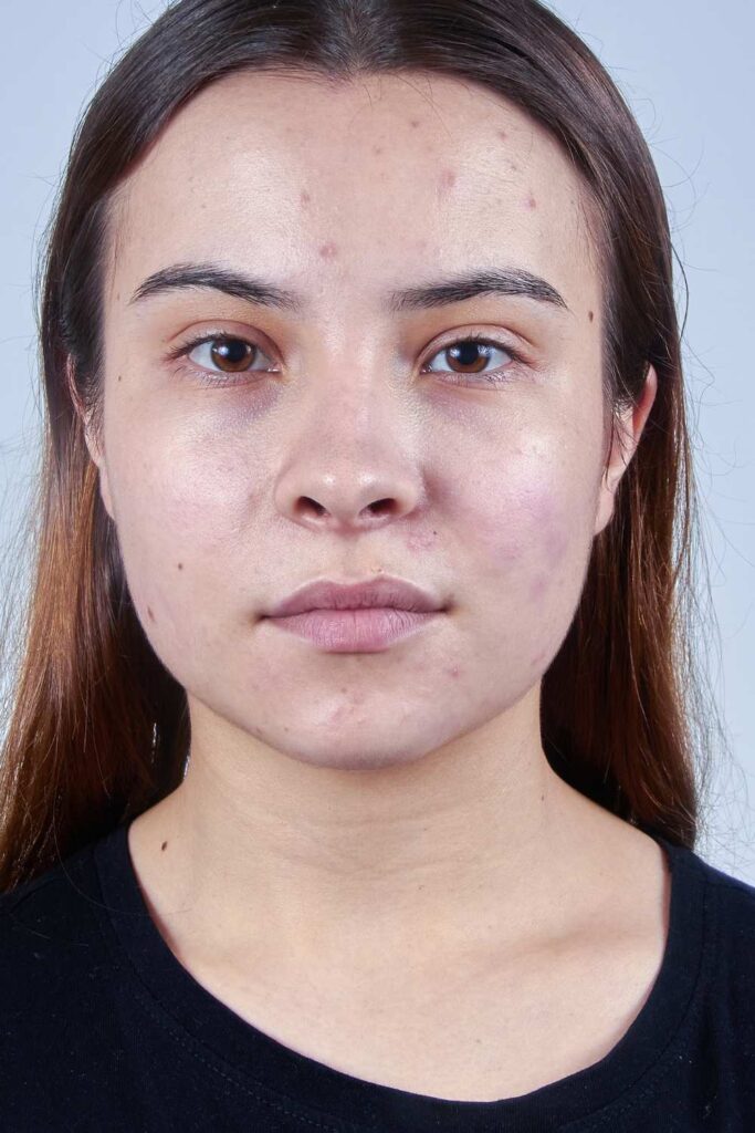 A lady with the combination of oily and dry face.