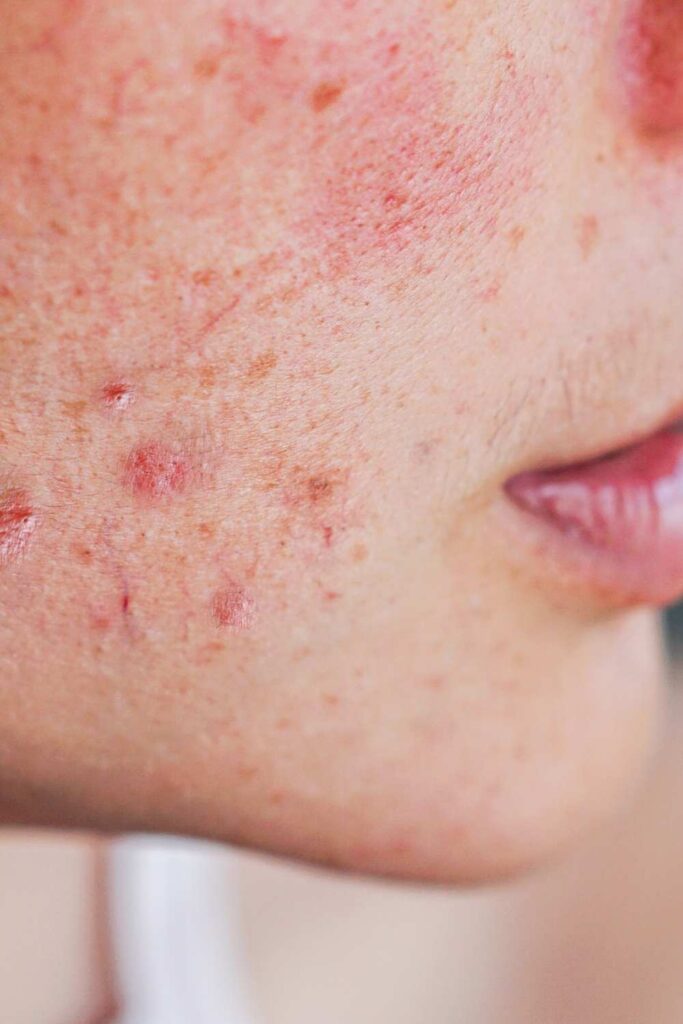 Sensitive face with red rash